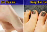 Muốn biết CÓ SỐ LÀM TỈ PHÚ hay không nhìn bàn chân sẽ thấy