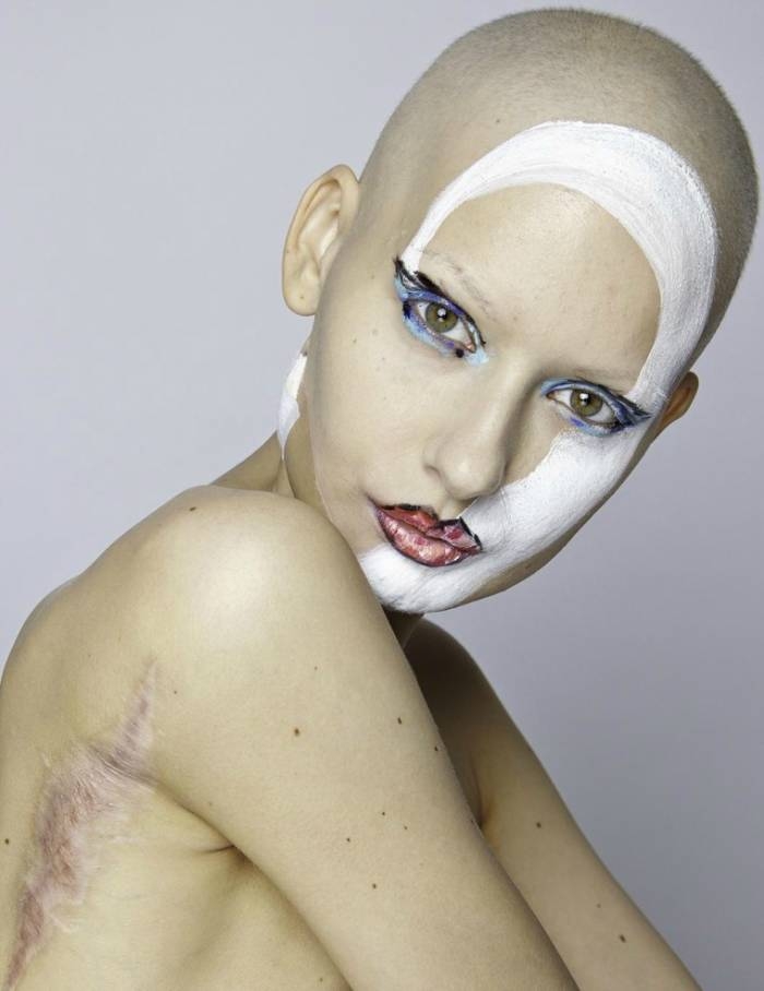 Người mẫu 25 tuổi phải cắt bỏ 95% xương hàm vì ung thư, sau điều trị vẻ xinh đẹp của cô khiến bao người rung động