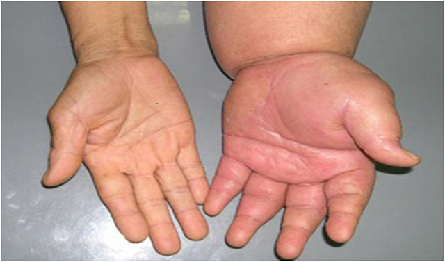 Sáng thức dậy nếu thấy cơ thể có dấu hiệu này chứng tỏ bạn sắp chạy thận cả đời rồi