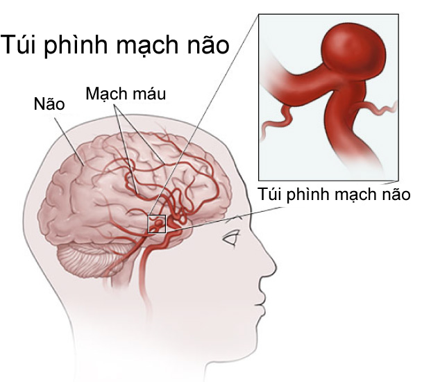 Bệnh phình động mạch não là gì?