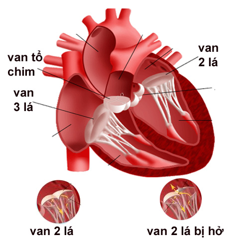 Hướng dẫn cách chăm sóc cho người bị bệnh hở van động mạch chủ