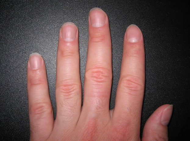 9 dấu hiệu của móng tay cho thấy cơ thể bạn đang gặp vấn đề: Móng trắng đục, xuất hiện viền đen, hãy cẩn thận