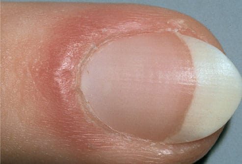 9 dấu hiệu của móng tay cho thấy cơ thể bạn đang gặp vấn đề: Móng trắng đục, xuất hiện viền đen, hãy cẩn thận