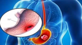 7 dấu hiệu nhận biết ung thu dạ dày ai cũng cần lưu tâm