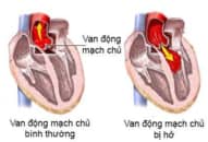 Bệnh hở van động mạch chủ là gì?