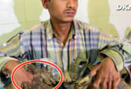 Mắc ‘bệnh người cây’, hai tay người đàn ông châu Á ‘mọc rễ’ kỳ dị