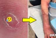 Cô gái đối mặt với tử thần chỉ vì vết xước nhỏ, đây chính là căn bệnh có thể gây CHẾT NGƯỜI sau VÀI GIỜ