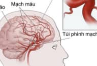 Bệnh phình động mạch não là gì?