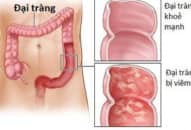 Bệnh viêm tá tràng là gì?