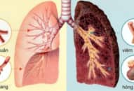Biểu hiện bạn đã mắc ung thư phổi giai đoạn đầu