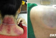 Cô gái được người nhà cạo gió, không ngờ trên thân xuất hiện hiện tượng này, bác sỹ xem xong nói… Thật nghiêm trọng