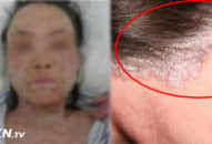 10 năm sống KHÔNG BẰNG CHẾT, không dám ngủ với chồng với căn bệnh còn kinh khủng hơn cả ung thư