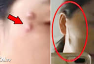 Sau khi phẫu thuật thẩm mỹ, cô gái mọc ‘con sâu dài’ trên má phải và lập tức đến bệnh viện kiểm tra thì…