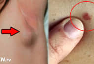 Những cảnh báo quan trọng có khi bạn đã mắc ung thư giai đoạn đầu