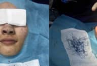 Búi chỉ xanh trong mũi của cô gái sau khi ‘dao kéo’