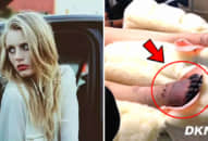 Người mẫu xinh đẹp bất tỉnh, bị cắt bỏ 1 chân vì thứ quen thuộc, các chị em nên chú ý