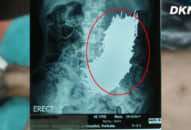 Hy hữu: Bác sỹ sùng nam châm hút 600 đinh sắt ra khỏi bụng bệnh nhân