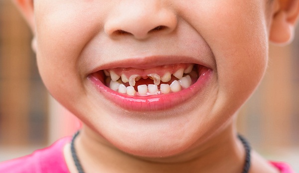 10 loại thực phẩm có thể khiến răng của bạn "đi cả hàm"