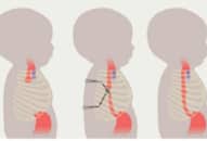 Mỹ cấy robot vào cơ thể trẻ sơ sinh để chữa bệnh