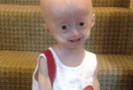 Em bé ‘người chim’ mới 8 tuổi đã qua đời vì… QUÁ GIÀ