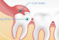 Tại sao cần phải nhổ răng khôn?