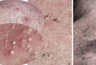 Mụn đầu đen, mụn cám sẽ tự ‘PHỤT RA’ mà không cần nặn đau đớn với thứ này