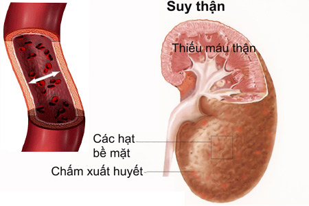 Những dấu hiệu khi đi tiểu cho biết bạn đã mắc bệnh thận nặng rồi đấy!