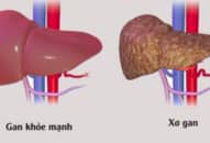 Thấy dấu hiệu này xuất hiện tới viện ngay vì bạn đã mắc bệnh xơ gan giai đoạn cuối đừng chủ quan kẻo muộn