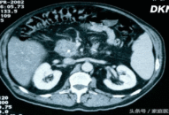 3 triệu chứng lớn của ung thư tuyến tụy