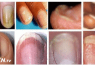 9 dấu hiệu của móng tay cho thấy cơ thể bạn đang gặp vấn đề: Móng trắng đục, xuất hiện viền đen, hãy cẩn thận