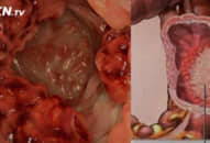 Mới 19 tuổi đã ung thư GIAI ĐOẠN CUỐI, bất kỳ ai cũng nên đọc để cứu sống mình