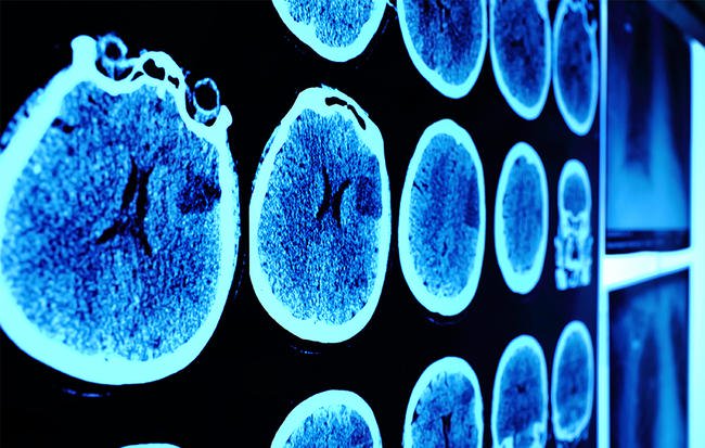 6 dấu hiệu cảnh báo chính xác bệnh u não, hãy khám ngay khi thấy có biểu hiện kẻo cứu chẳng kịp
