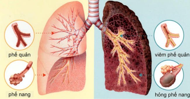 Biểu hiện bạn đã mắc ung thư phổi giai đoạn đầu: Chuyên gia nhắc dù 1 dấu hiệu nhỏ cũng không nên bỏ qua