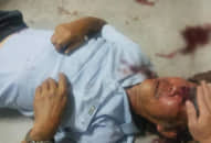 Người đàn ông 68 tuổi bị bảo vệ chung cư đánh gãy sống mũi vì… đậu xe sai