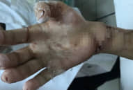 Ca phẫu thuật thần kỳ 9 giờ nối lại bàn tay bị côn đồ chém ĐỨT RỜI của nhân viên quán karaoke