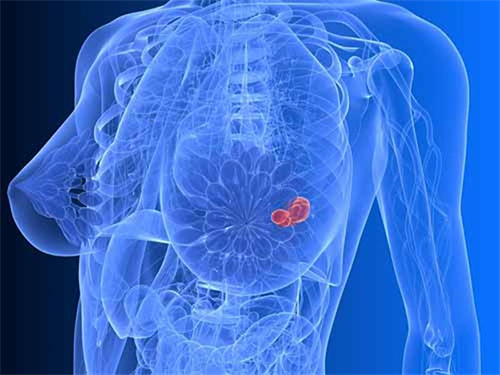 Các loại bệnh về ung thư của nữ giới thường gặp nhất