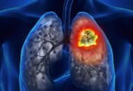 Cách phòng tránh căn bệnh ung thư phổi