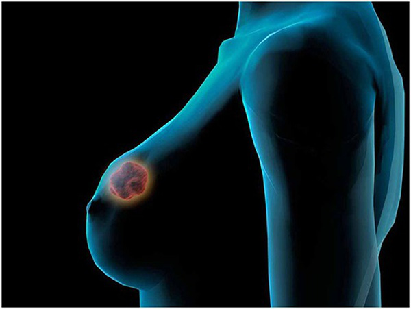 Trên da xuất hiện những dấu hiệu này, 99,99% chị em bị ung thư vú cực cao