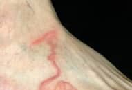 Chân sưng tấy do giun móc ký sinh sau khi du lịch biển