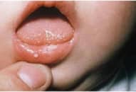 Chớ chủ quan khi con nhỏ xuất hiện các nốt nhỏ ở miệng