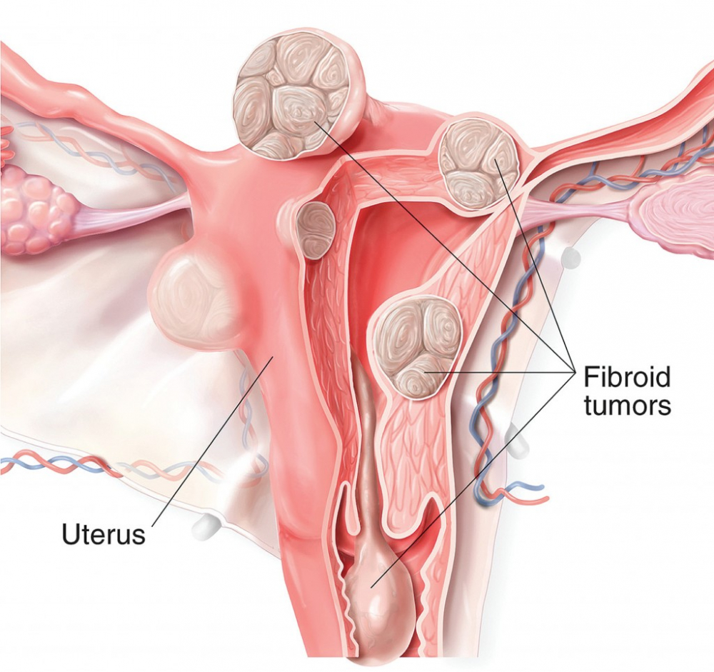 Nguyên nhân dẫn đến u xơ tử cung là do đâu - điều chị em phụ nữ cần đặc biệt lưu ý