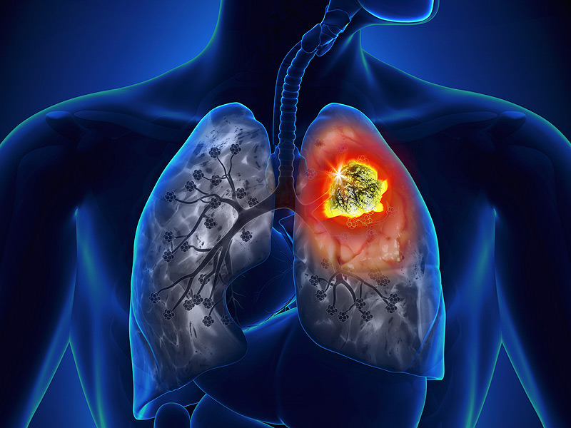Cách phòng tránh căn bệnh ung thư phổi