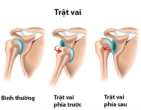 Suýt liệt tay vì bó thuốc nam chữa gãy trật khớp vai