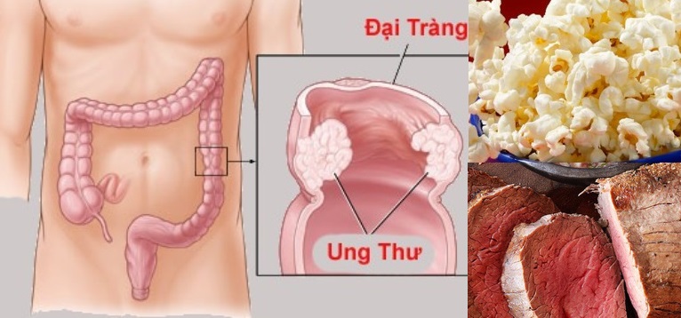 Chỉ mặt 2 loại thực phẩm được nhiều người ăn mỗi ngày làm tăng nguy cơ mắc bệnh ung thư đại tràng cực cao