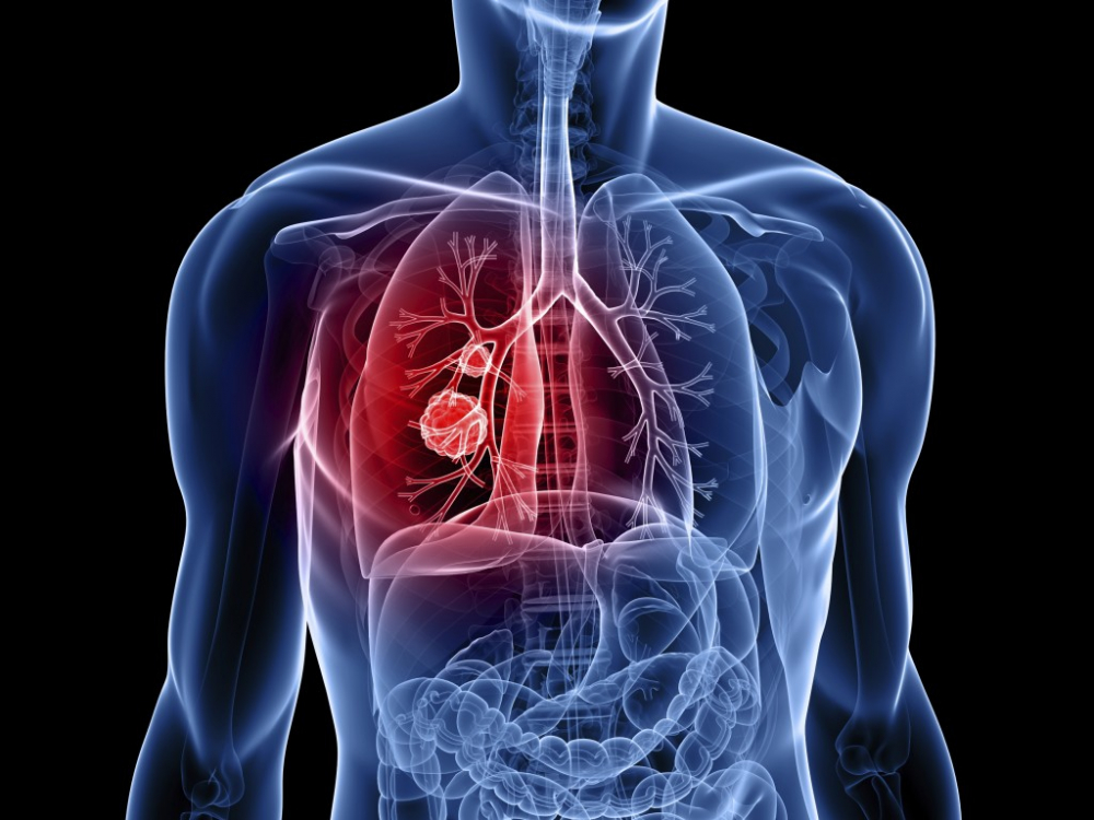 Ung thư phổi là gì - là điều ai ai cũng cần biết để phòng tránh ngay