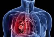 Ung thư phổi là gì – là điều ai ai cũng cần biết để phòng tránh ngay