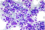 Mỹ thử nghiệm văcxin ung thư trên người