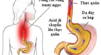Cảnh báo biến chứng nguy hiểm từ trào ngược dạ dày thực quản