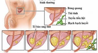 Góc chuyên gia: Khi nào thì nên mổ u xơ tuyến tiền liệt