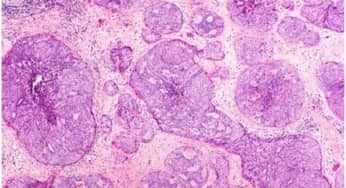 Anh phát hiện 110 loại gene gây nguy cơ ung thư vú